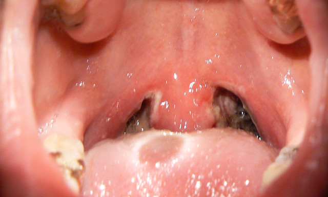 Tonsillectomy Flickr Photo Sharing