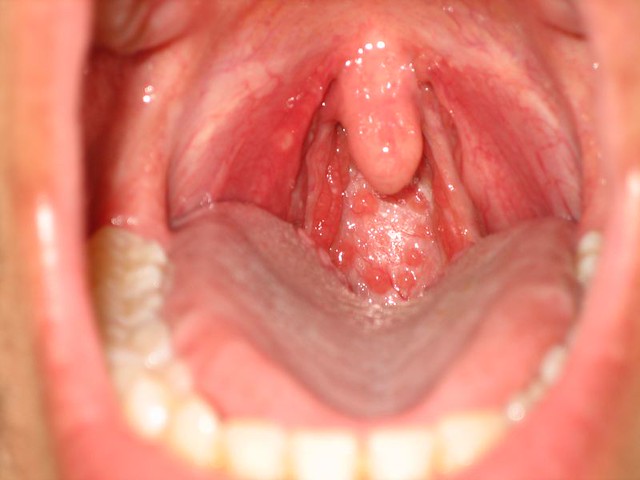bumps on tongue and throat - Ear, Nose &.