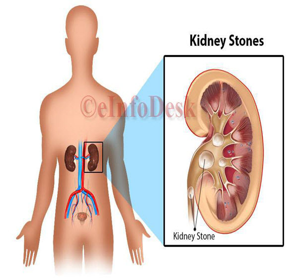 Kidney Stones Representation