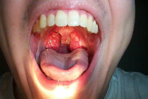 Strep throat untreated in adults