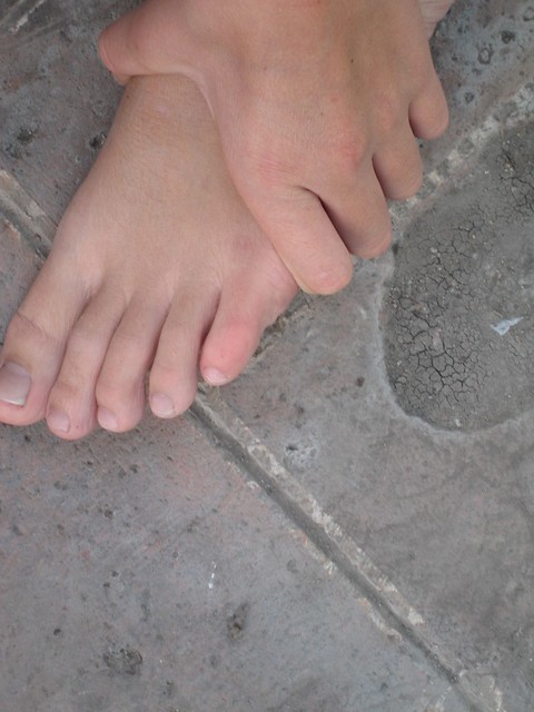 broken-pinky-toe-flickr-photo-sharing