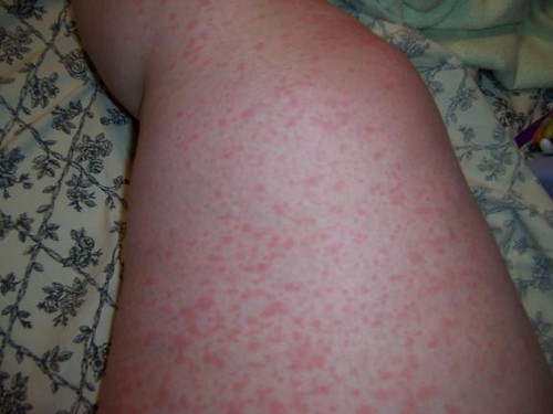 Scarlet Fever Fact Sheet - Infectious Diseases - Public ...