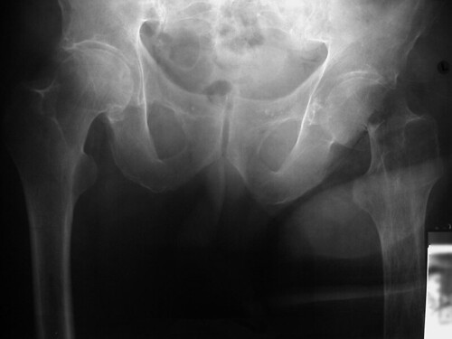 Insufficiency fracture, left femoral neck, due to disuse osteoporosis from amputation, pelvis