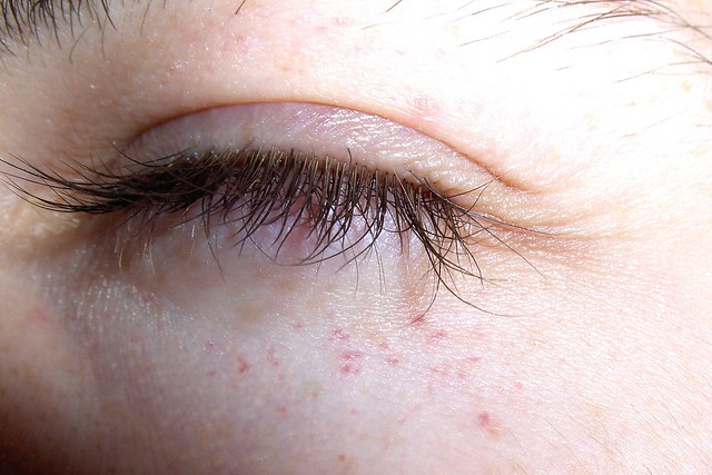 Causes of Rash around Eyes and How to Get Rid of them with ...