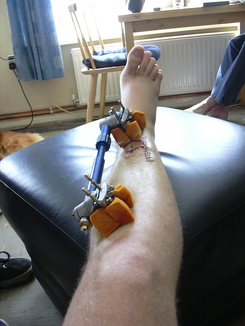 my broken leg | Flickr - Photo Sharing!