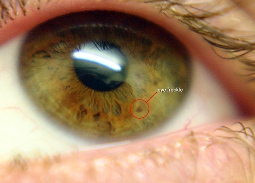 freckle eye