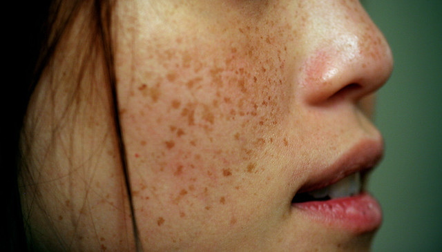 lips, nose, face, freckles