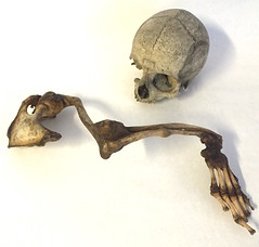 Kranium og højre arm til skelet af en 16 årig kvindelig Idiot