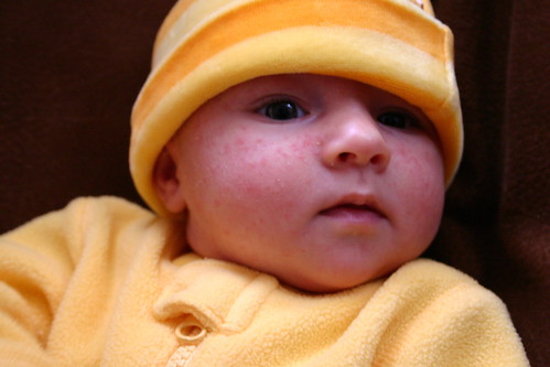 baby acne pictures