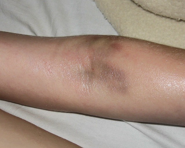 Post Blood Draw Bruise Flickr Photo Sharing!