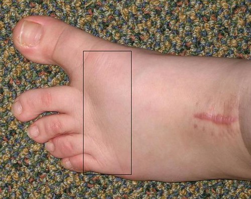 Swelling On Top Of Feet 81
