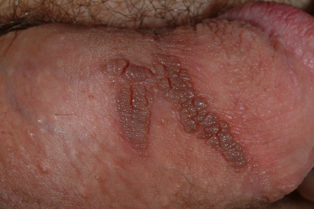 Genital Warts | STD Symptoms, Treatment and Removal