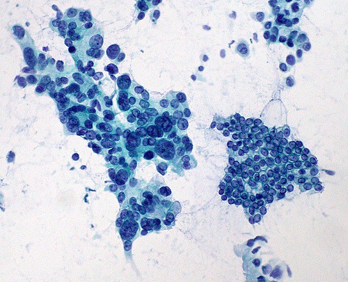 Pancreas FNA; adenocarcinoma vs. normal ductal epithelium (200x)
