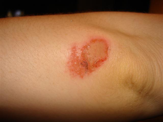 carpet-burn-on-elbow-www-resnooze