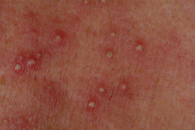 drug allergy rash