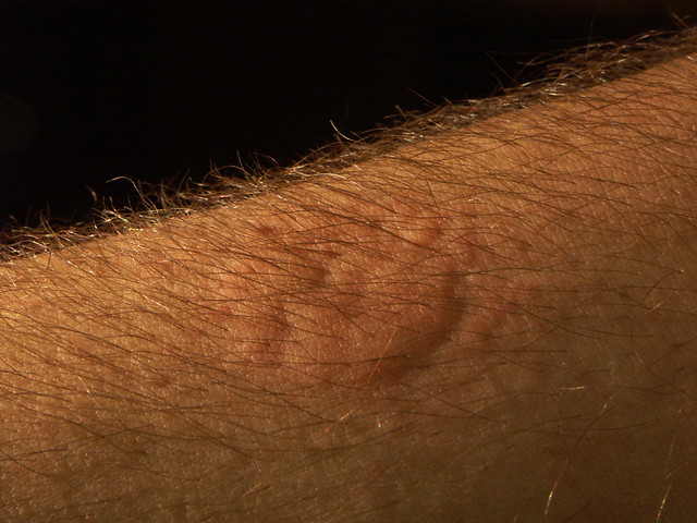dorsal view of arm, bed bug colony feeding | Flickr - Photo Sharing!