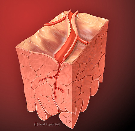 Heart coronary artery blockage