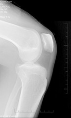 Side view knee xray