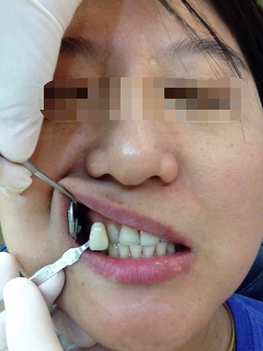 高雄前金區牙醫推薦_高雄西河牙醫診所_居家牙齒美白 (5)