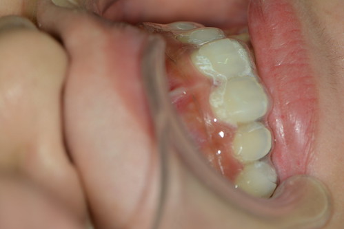 如何避免牙齒美白造成不適？那些權泓牙醫黃泓傑醫師教我的事 (9)