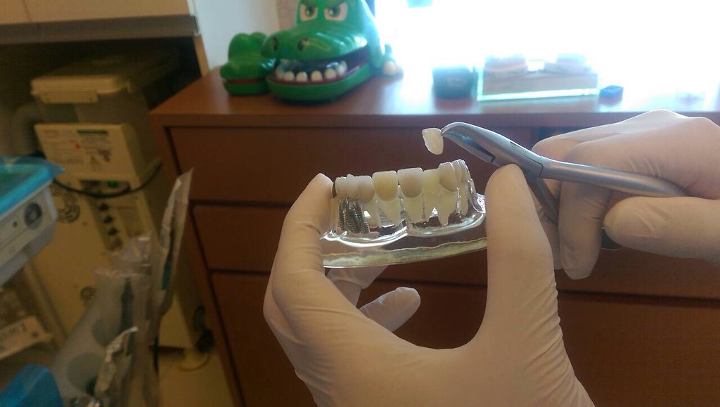 不想讓美國人笑我牙齒髒 台中豐美牙醫陶瓷貼片打造我的完美微笑曲線 (4)