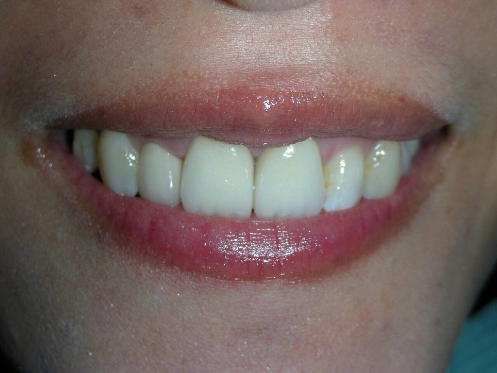 不想讓美國人笑我牙齒髒 台中豐美牙醫陶瓷貼片打造我的完美微笑曲線 (6)