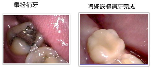 [台南] 補蛀牙有更好的選擇！讓佳美牙醫塗祥慶醫師告訴你01 (1)