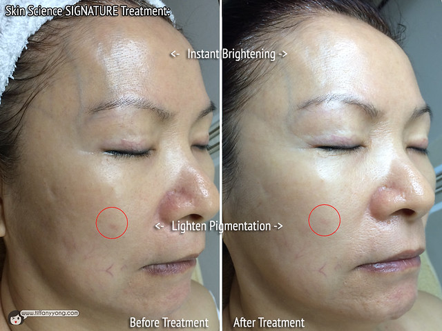 Skin Science Signature Treatment Before After