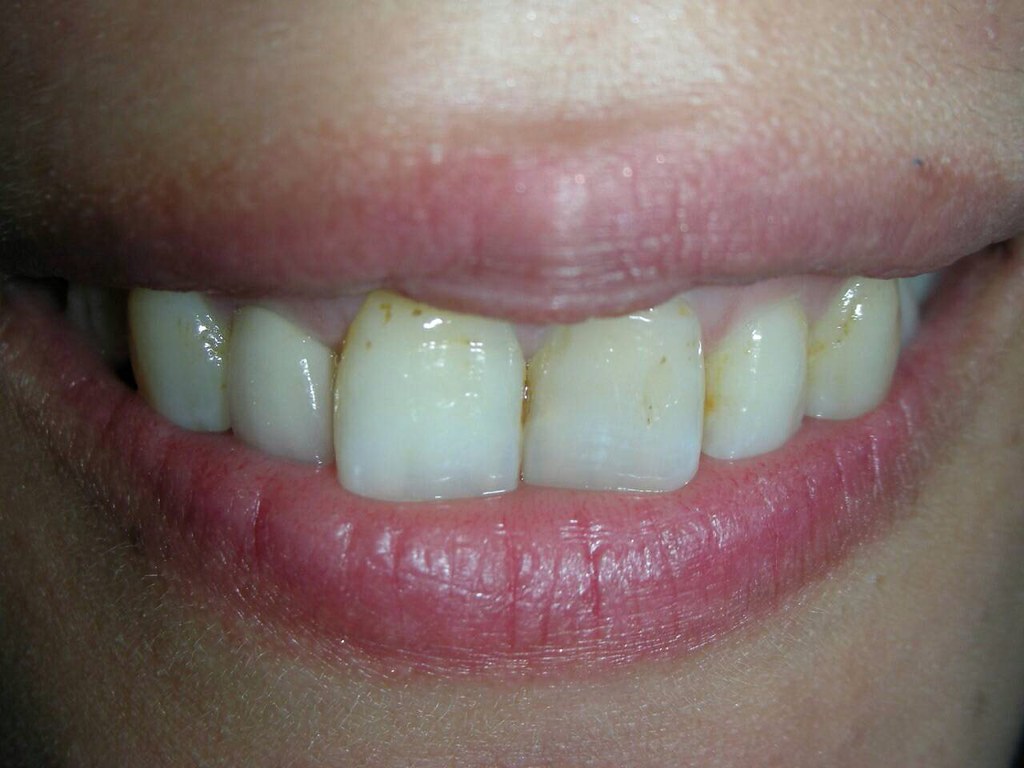 不想讓美國人笑我牙齒髒 台中豐美牙醫陶瓷貼片打造我的完美微笑曲線 (5)