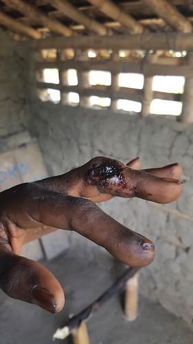 fractured finger_Kesonga