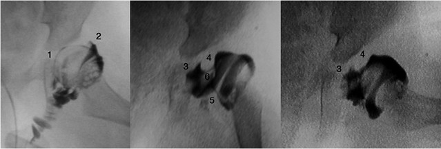 Figura 6 - Artrografía de cadera en la DDC en el neonato