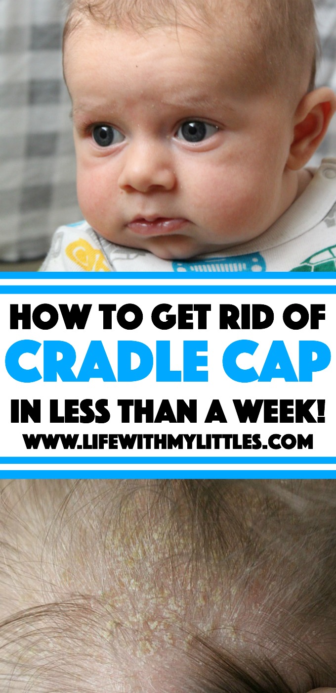 Not sure how to get rid of cradle cap? Here's an easy and inexpensive treatment that works in less than a week! 