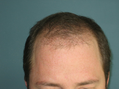 50 Days After Bosley Hair Restoration Procedure