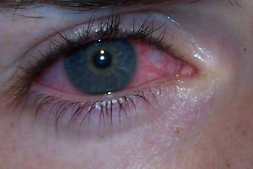 Am 47 de ochi care se înrăutățesc vedere care afectează boala