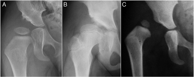 Figura 1 - Displasia acetabular (A), Subluxación de la cadera (B) y Luxación de la cadera (C)