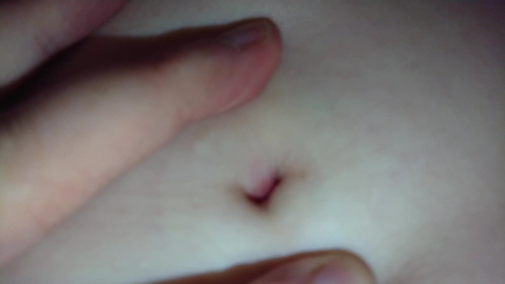my runny stinky belly button. for medical purpose.