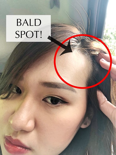 Beijing 101 Post Natal Hair Loss Treatment